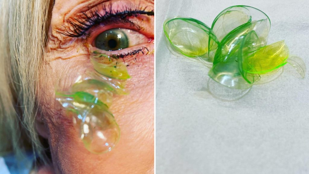 Una oftalmóloga remueve 23 lentes de contacto alojadas en el ojo de una anciana