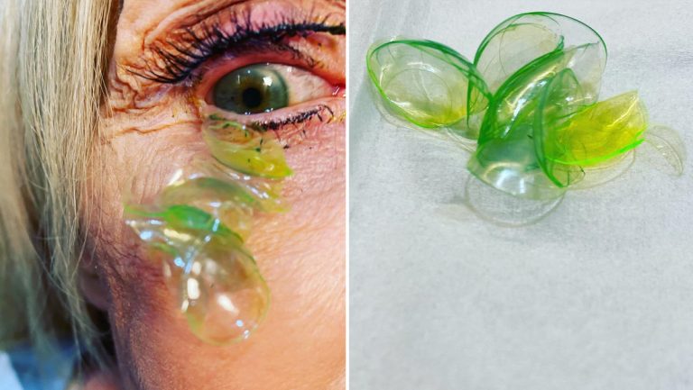 Una oftalmóloga remueve 23 lentes de contacto alojadas en el ojo de una anciana