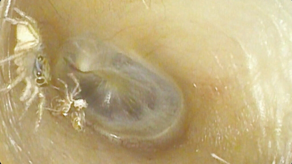 Un médico descubre la 'aterradora' razón por la que una mujer oía ruidos en su oreja