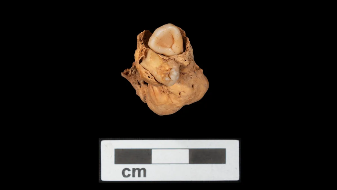 Encuentran un raro tumor de ovario con dientes en una tumba de hace 3.000 años en Egipto