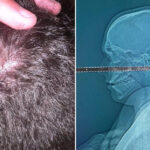 Recibe un disparo en la cabeza en una fiesta y solo descubre que tenía una bala en el cerebro 4 días después