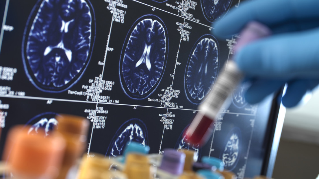 Medicamentos "revolucionarios" contra alzhéimer provocan una reducción del tamaño del cerebro