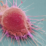 La IA revela que el cáncer de próstata se divide en dos subtipos diferentes