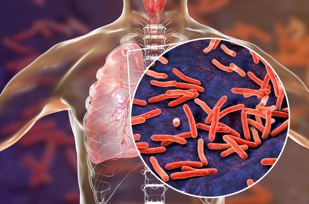 Declaran emergencia de salud pública por un brote local de tuberculosis en EE.UU.