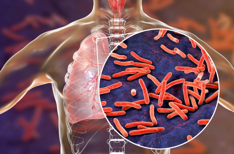Declaran emergencia de salud pública por un brote local de tuberculosis en EE.UU.