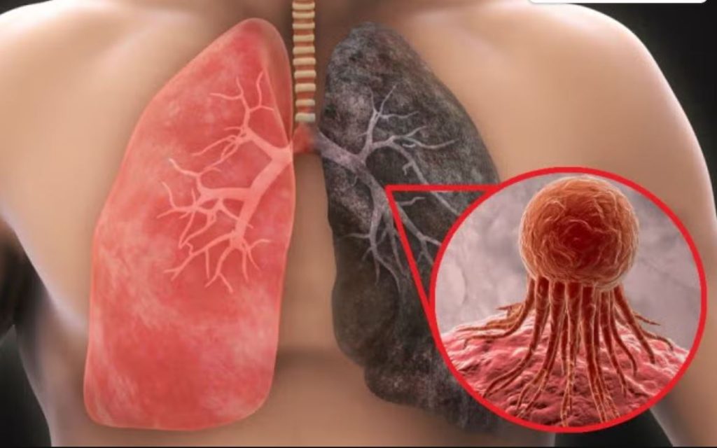 Un gráfico de cómo se miraría el cáncer de pulmón.